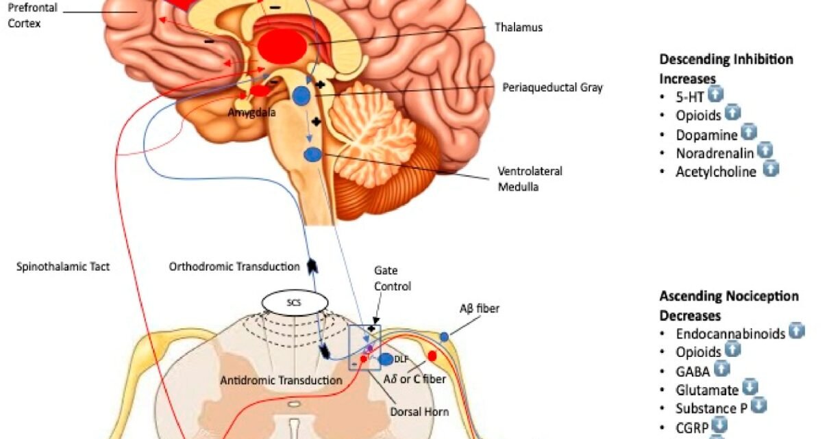 Understanding Neuromodulation: A Modern Solution for Chronic Pain Relief